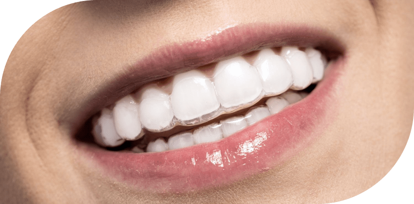 L’alignement des dents par gouttières invisibles
